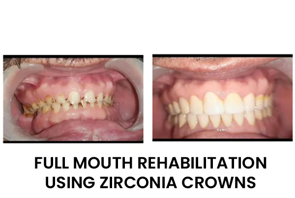 Full Mouth Rehabilitation Using Zirconia Crowns