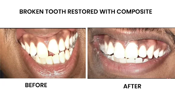 Broken Tooth Restored With Composite