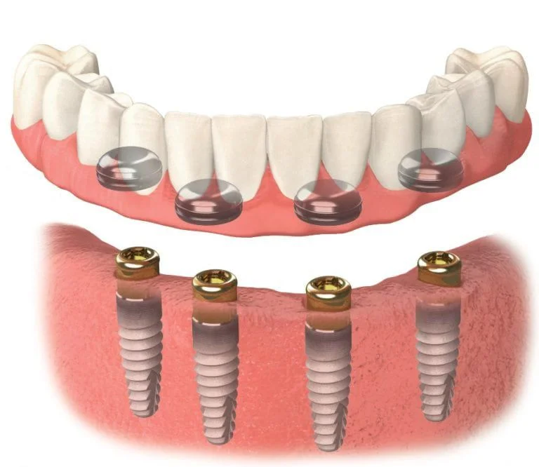 Implant Supported Dentures