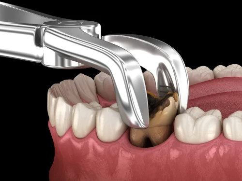 Dental Extraction