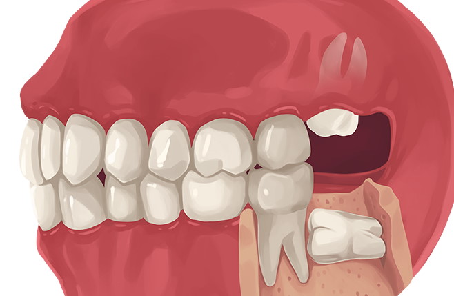 Wisdom Tooth Removal